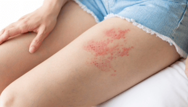 shingles vaccine sudbury
