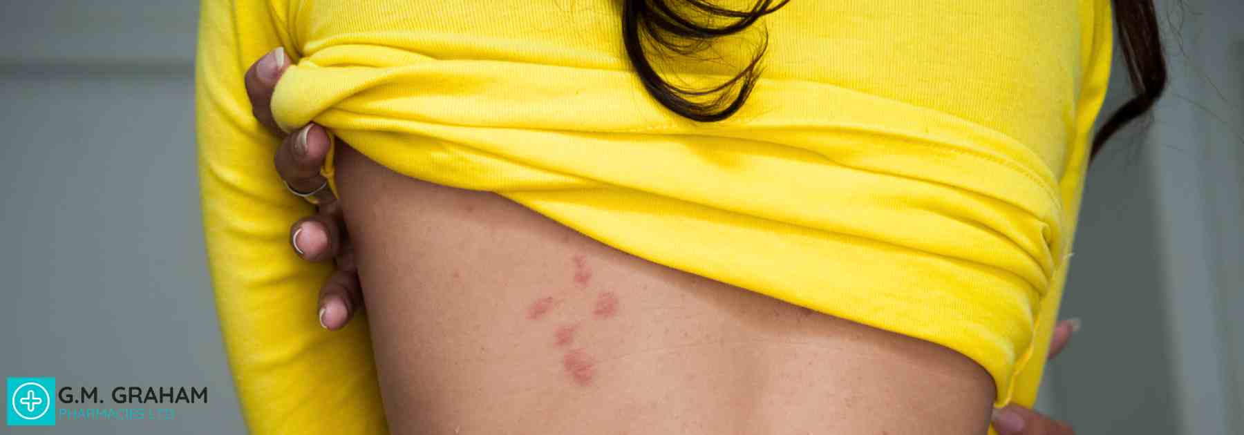 infected insect bites